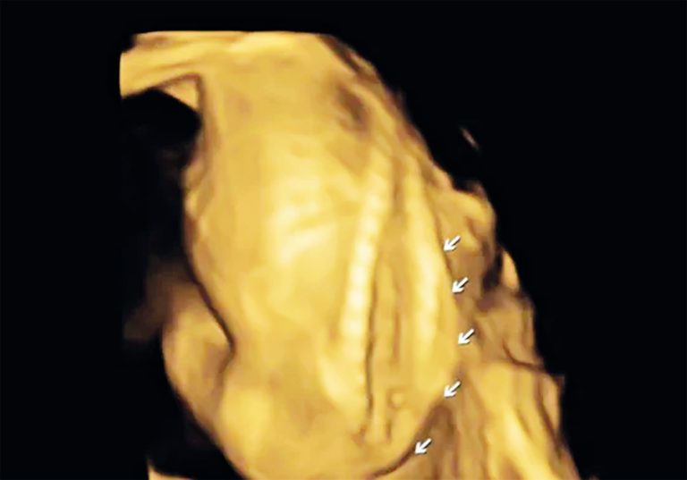 Ainda na barriga, bebê de Morro da Fumaça precisa de cirurgia urgente