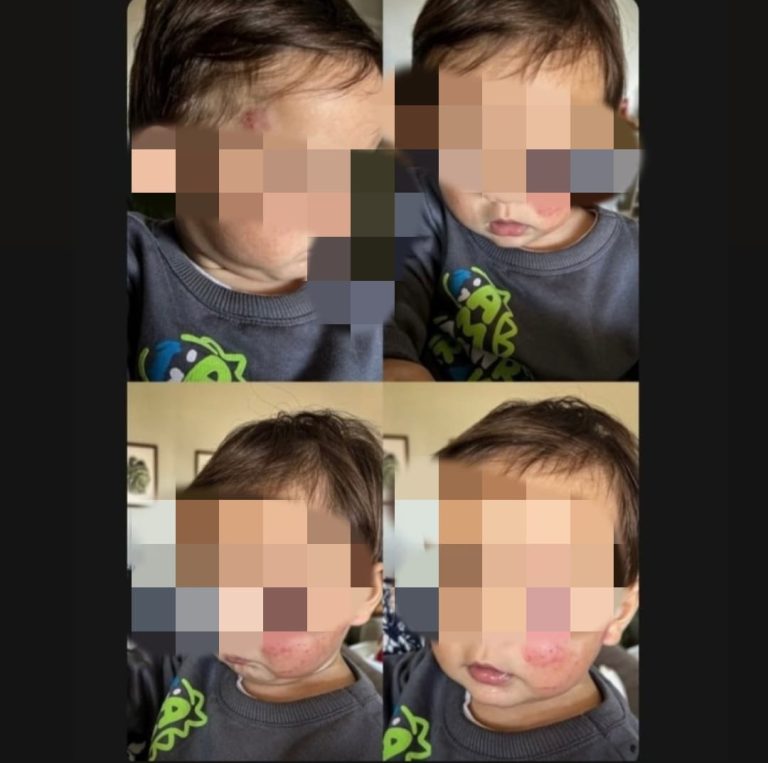 Bebê volta para casa com hematomas no rosto após ser mordido em creche