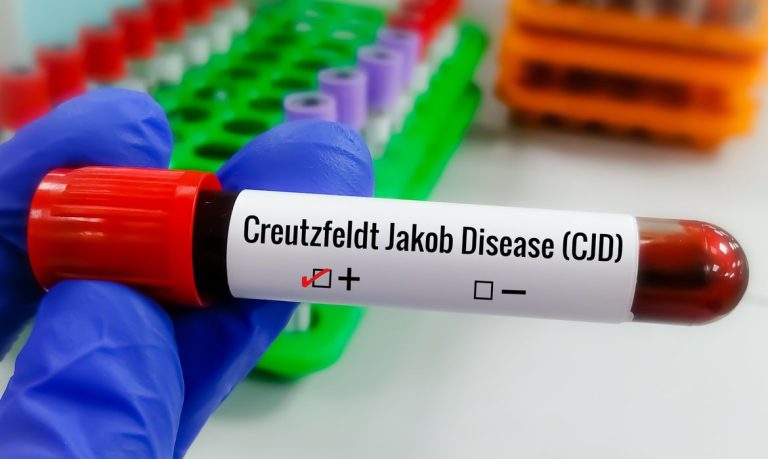 Entenda Doença de Creutzfeldt-Jakob, diagnóstico de Lito Sousa