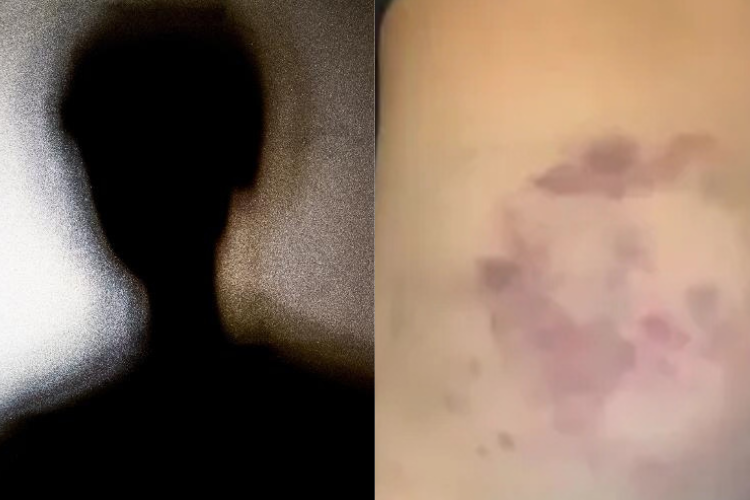 (VÍDEO) Pai agride filho de 5 anos e o deixa com graves hematomas